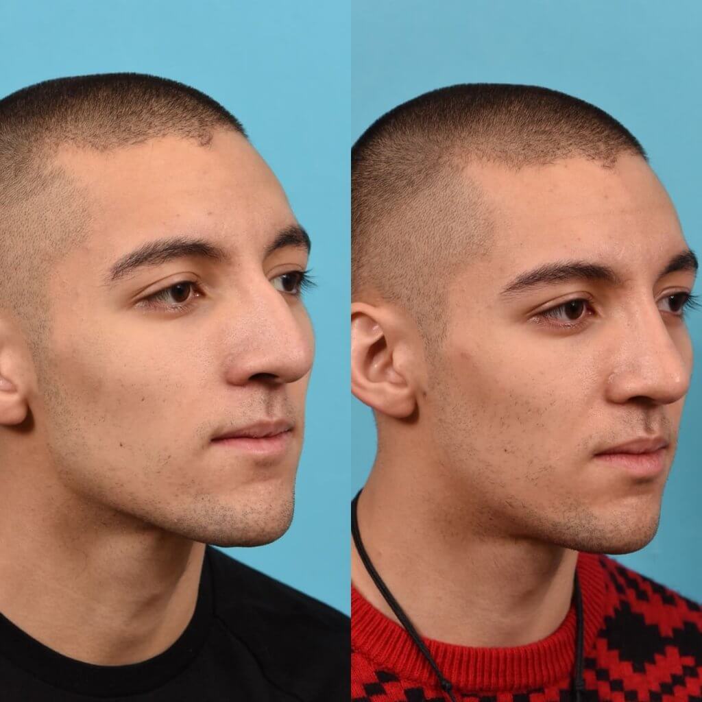 young male patient before and after rhinoplasty - right side
