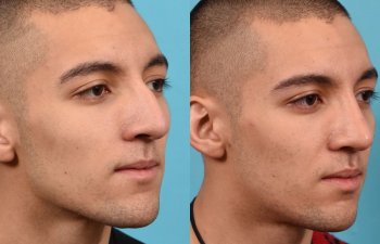 young male patient before and after rhinoplasty - right side