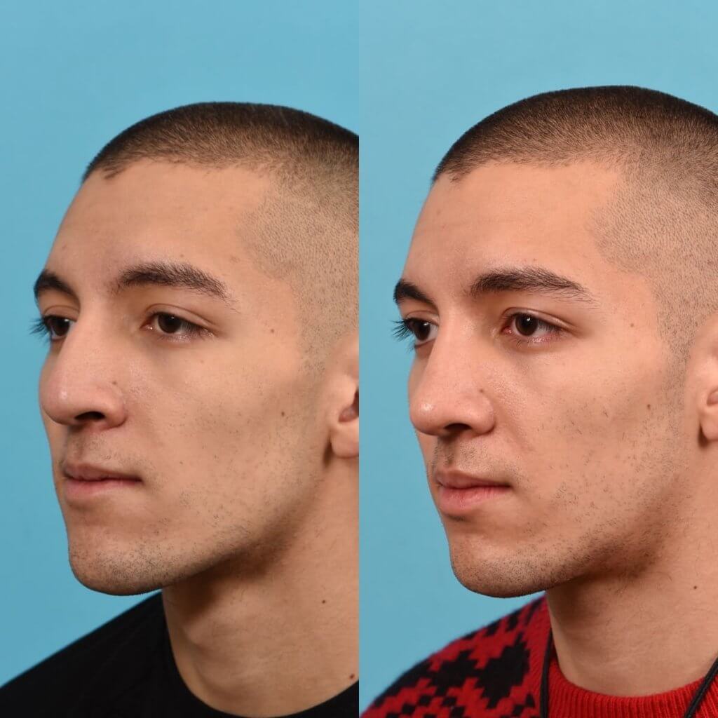 young male patient before and after rhinoplasty - left side