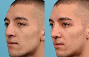 young male patient before and after rhinoplasty - left side