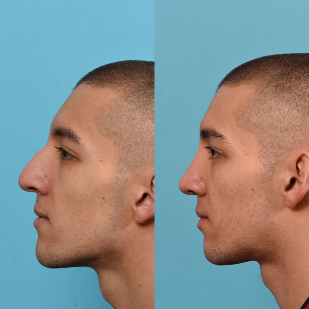 young male patient before and after rhinoplasty - left side