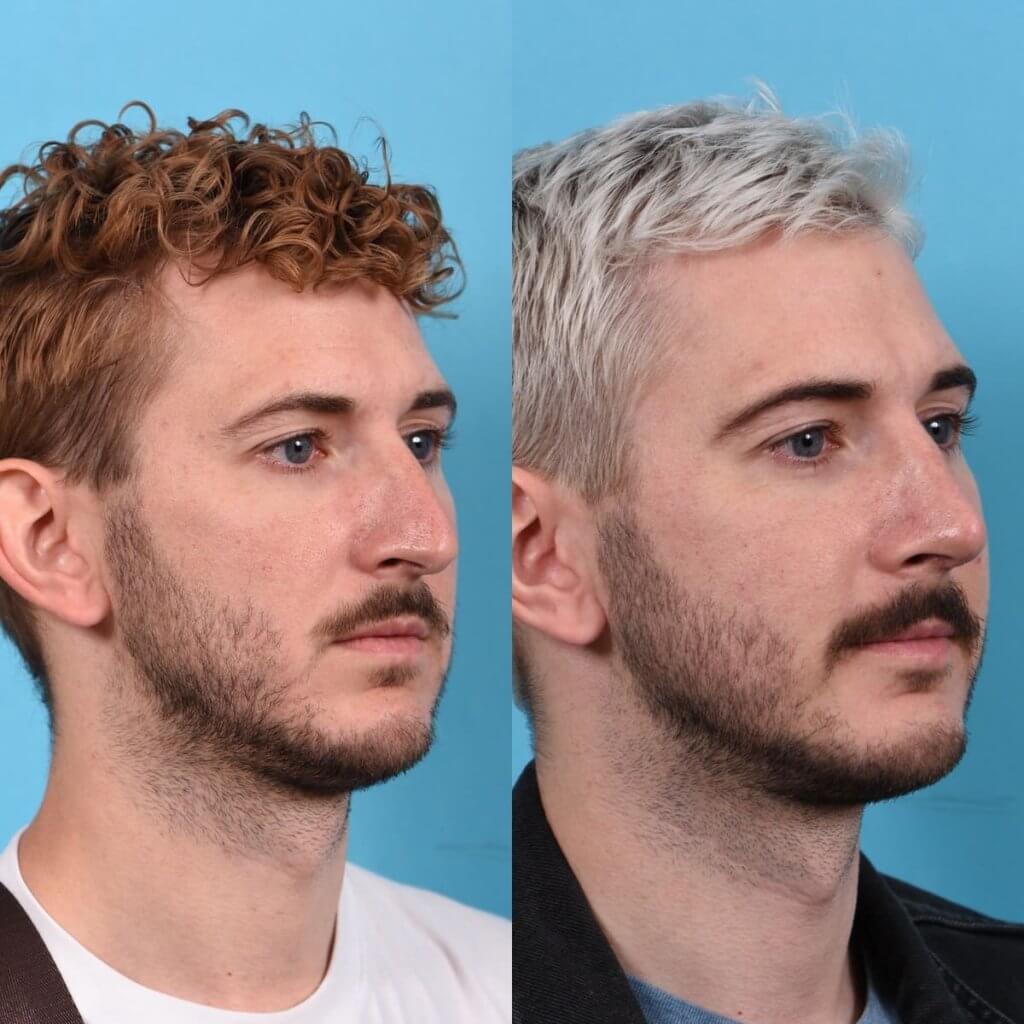 Male Patient Before and After Rhinoplasty