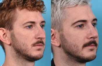 Male Patient Before and After Rhinoplasty