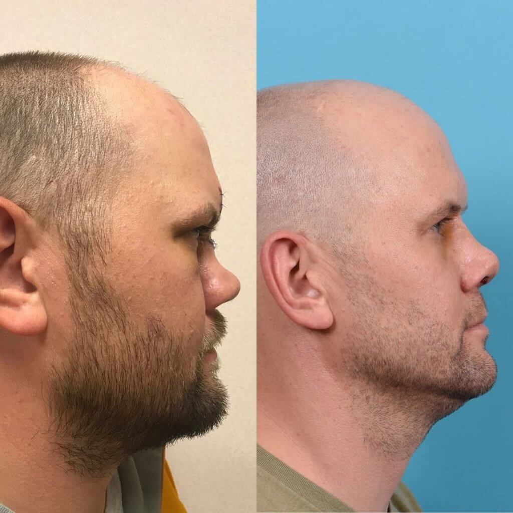 Male Patient Before and After Rhinoplasty