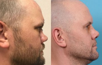 Male Patient Before and After Rhinoplasty