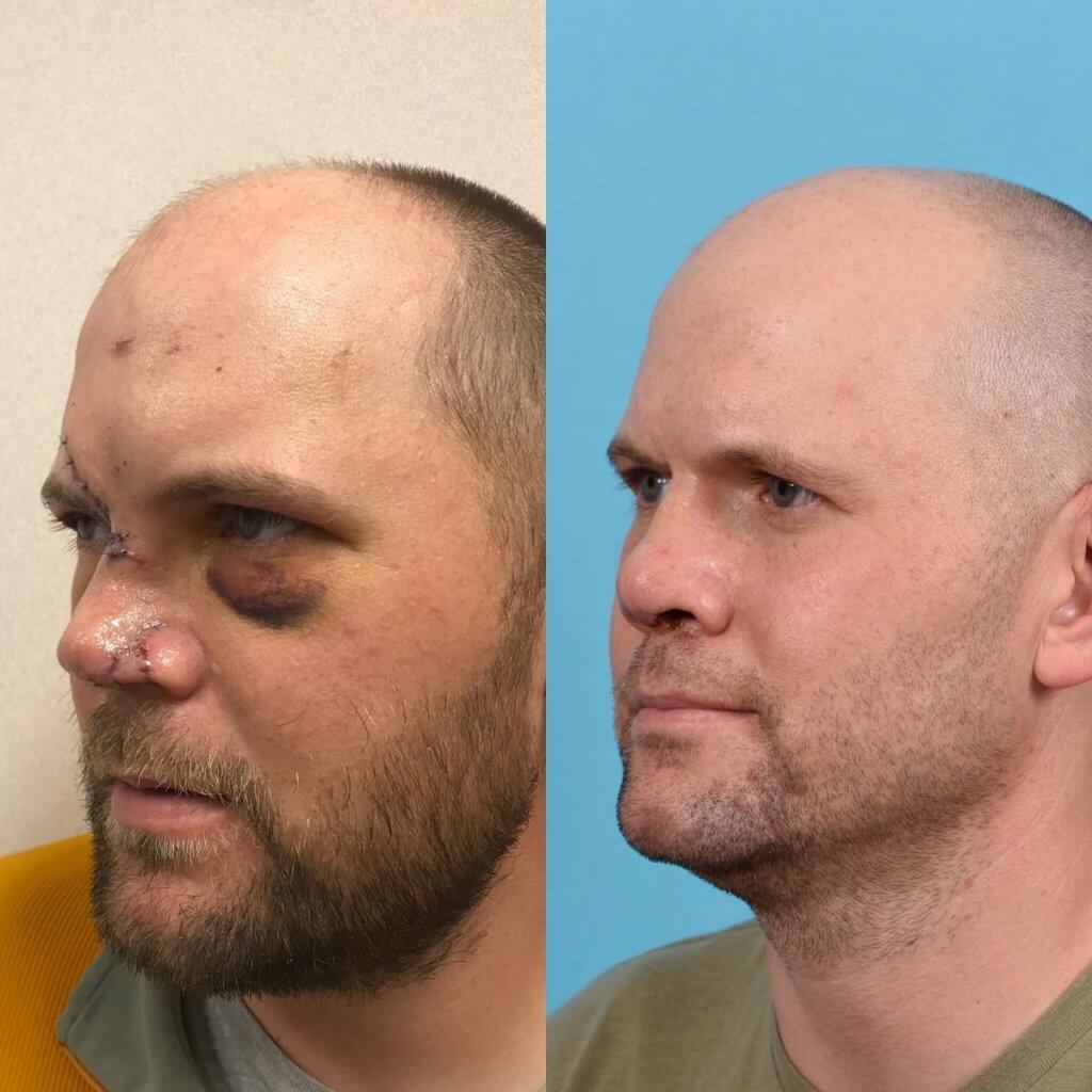 Male Patient Before and After Rhinoplasty