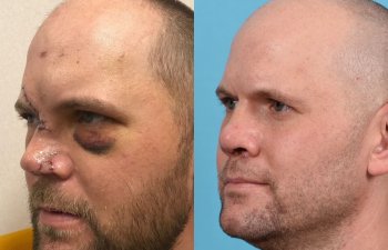 Male Patient Before and After Rhinoplasty