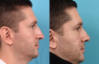 Male patient before and after rhinoplasty - Right Side