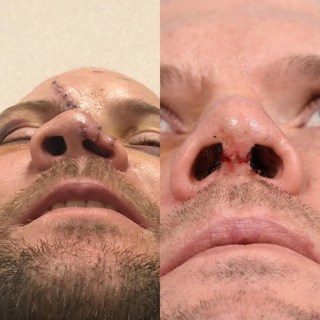 Male Patient Before and After Rhinoplasty