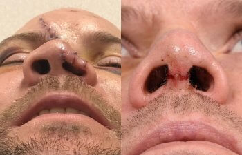 Male Patient Before and After Rhinoplasty