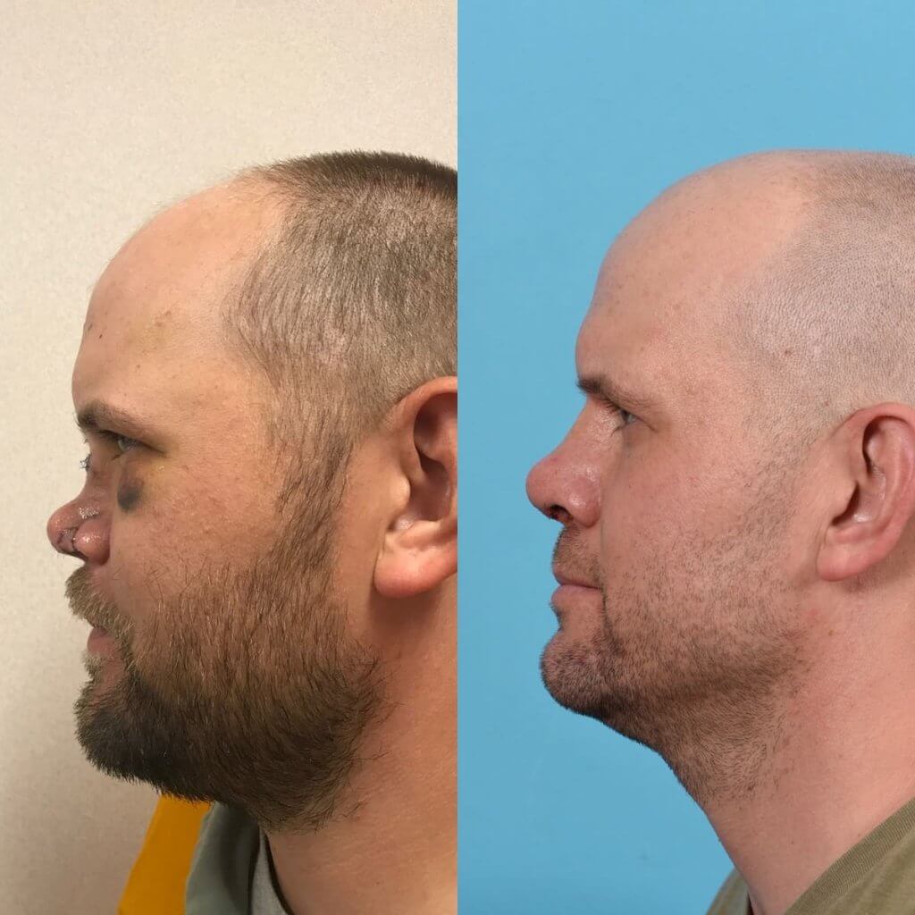 Male Patient Before and After Rhinoplasty