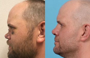 Male Patient Before and After Rhinoplasty