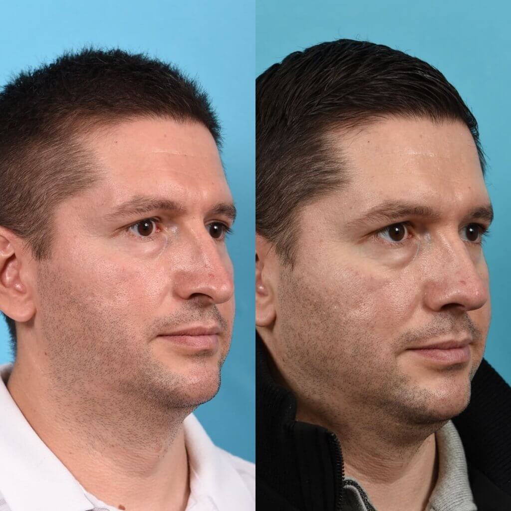 Male patient before and after rhinoplasty - Right Side