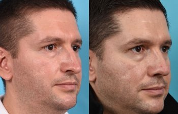 Male patient before and after rhinoplasty - Right Side