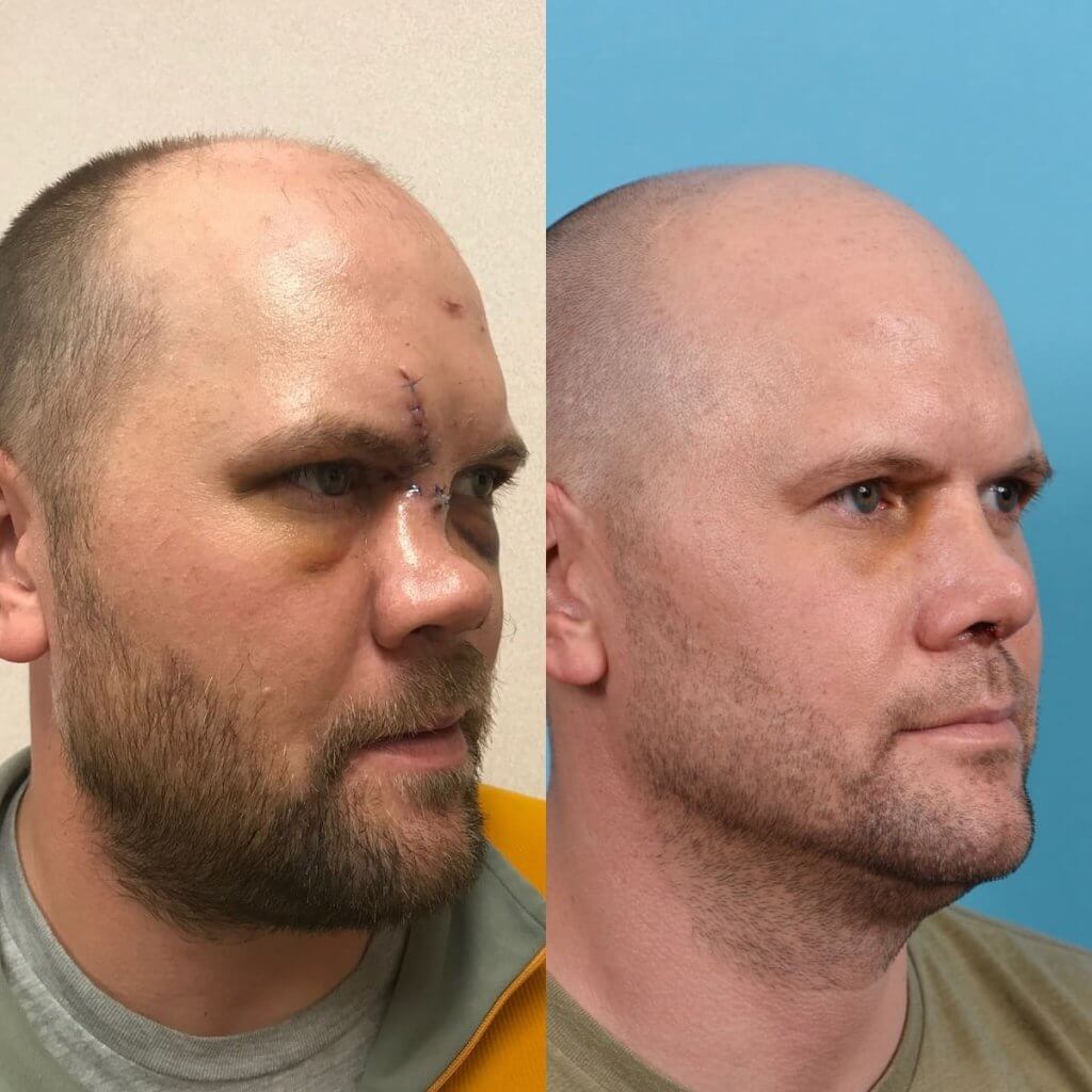 Male Patient Before and After Rhinoplasty