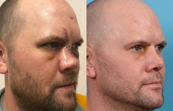 Male Patient Before and After Rhinoplasty