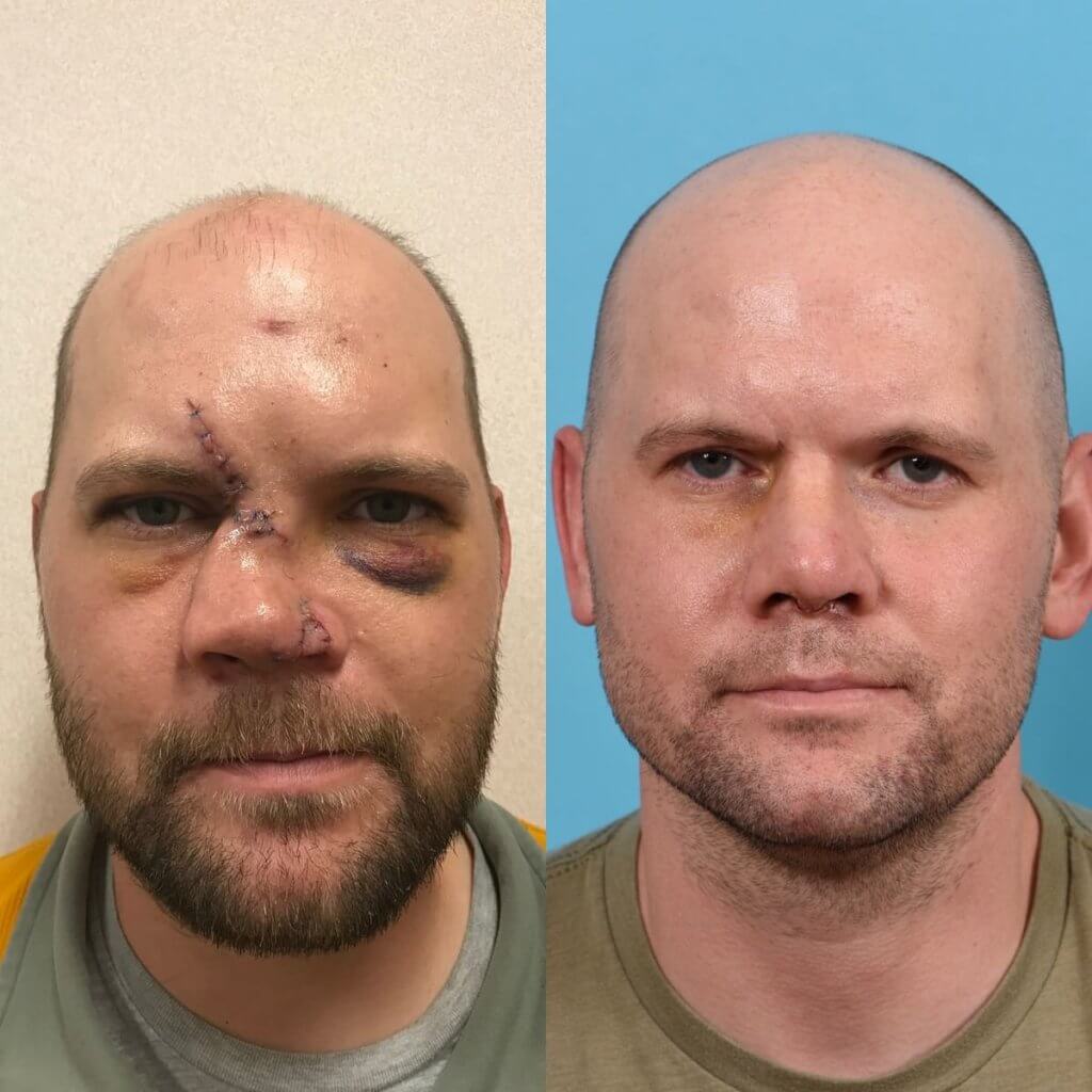 Male Patient Before and After Rhinoplasty