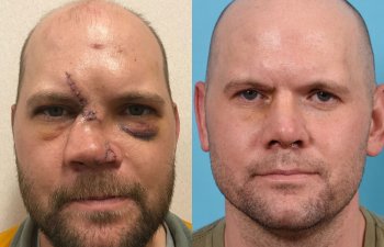 Male Patient Before and After Rhinoplasty