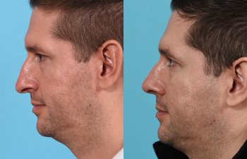Male patient before and after rhinoplasty - Left Side
