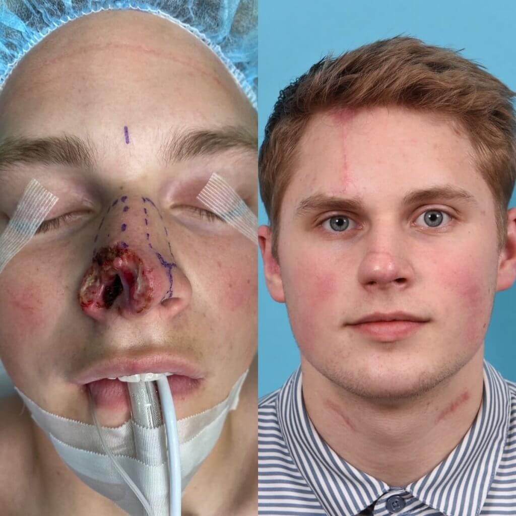 Male patient reconstruction surgery before and after.
