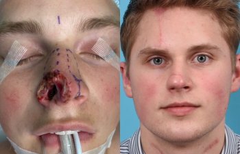 Male patient reconstruction surgery before and after.