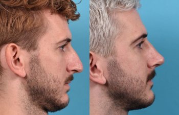 Male Patient Before and After Rhinoplasty