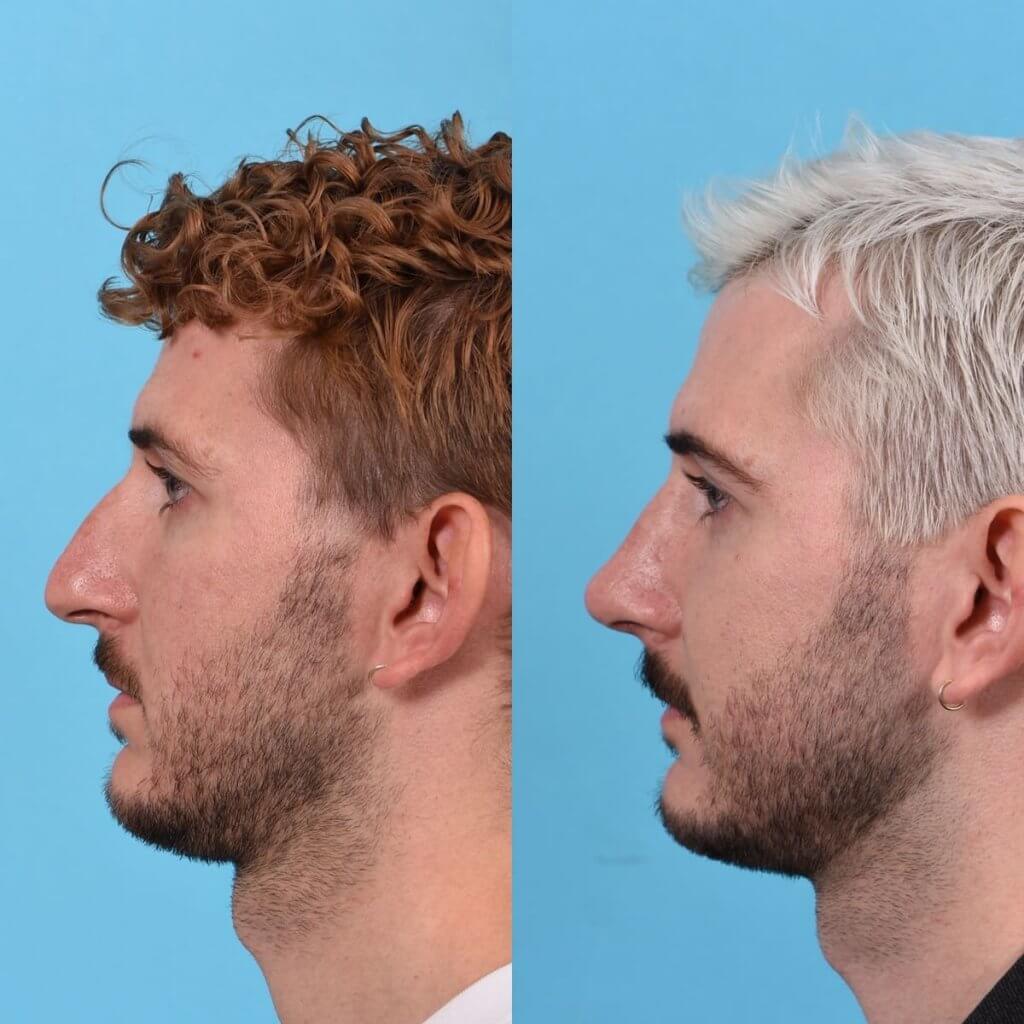 Male Patient Before and After Rhinoplasty