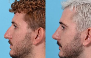 Male Patient Before and After Rhinoplasty