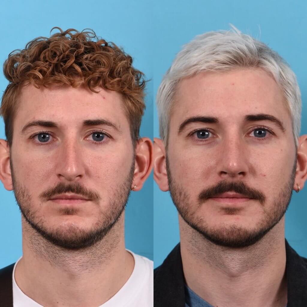 Male Patient Before and After Rhinoplasty