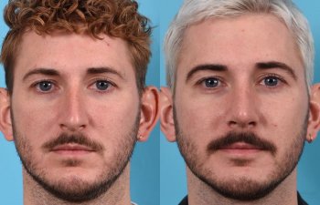 Male Patient Before and After Rhinoplasty