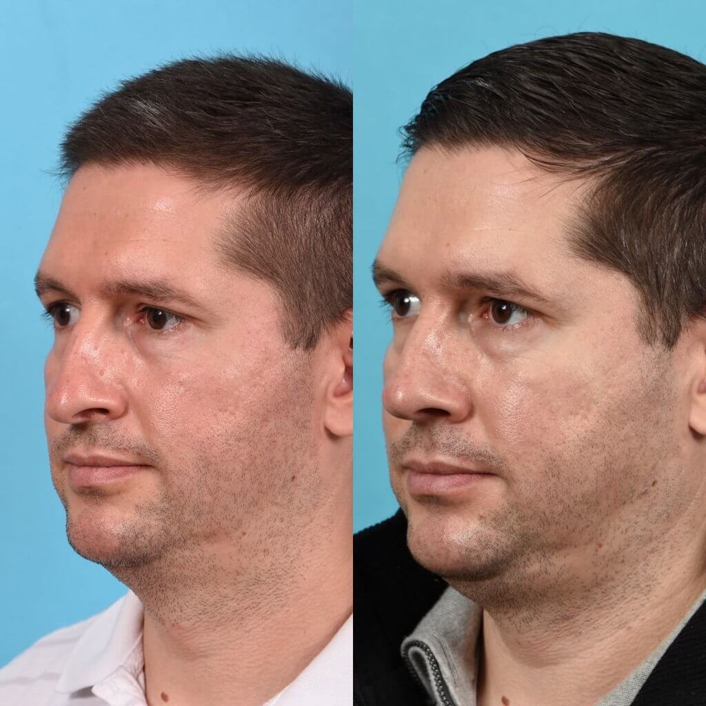 Male patient before and after rhinoplasty - Left Side