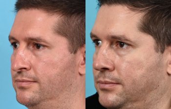 Male patient before and after rhinoplasty - Left Side