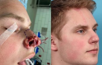 Male patient reconstruction surgery before and after.