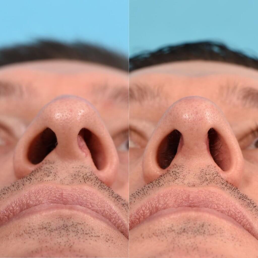 Male patient before and after rhinoplasty - Front