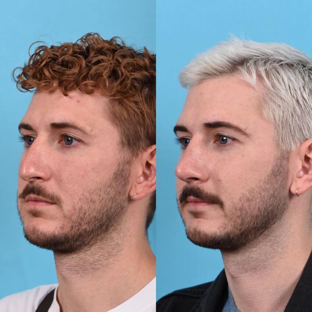 Male Patient Before and After Rhinoplasty
