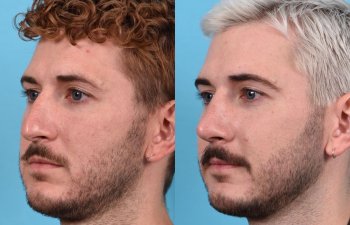 Male Patient Before and After Rhinoplasty