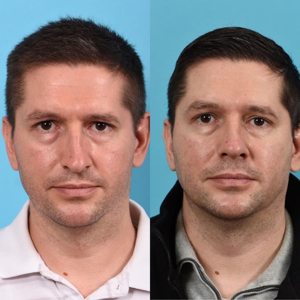 Male patient before and after rhinoplasty - Front
