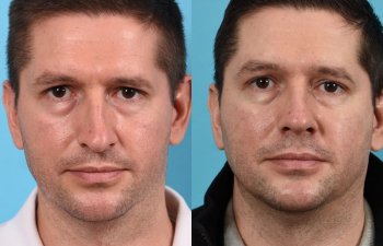 Male patient before and after rhinoplasty - Front
