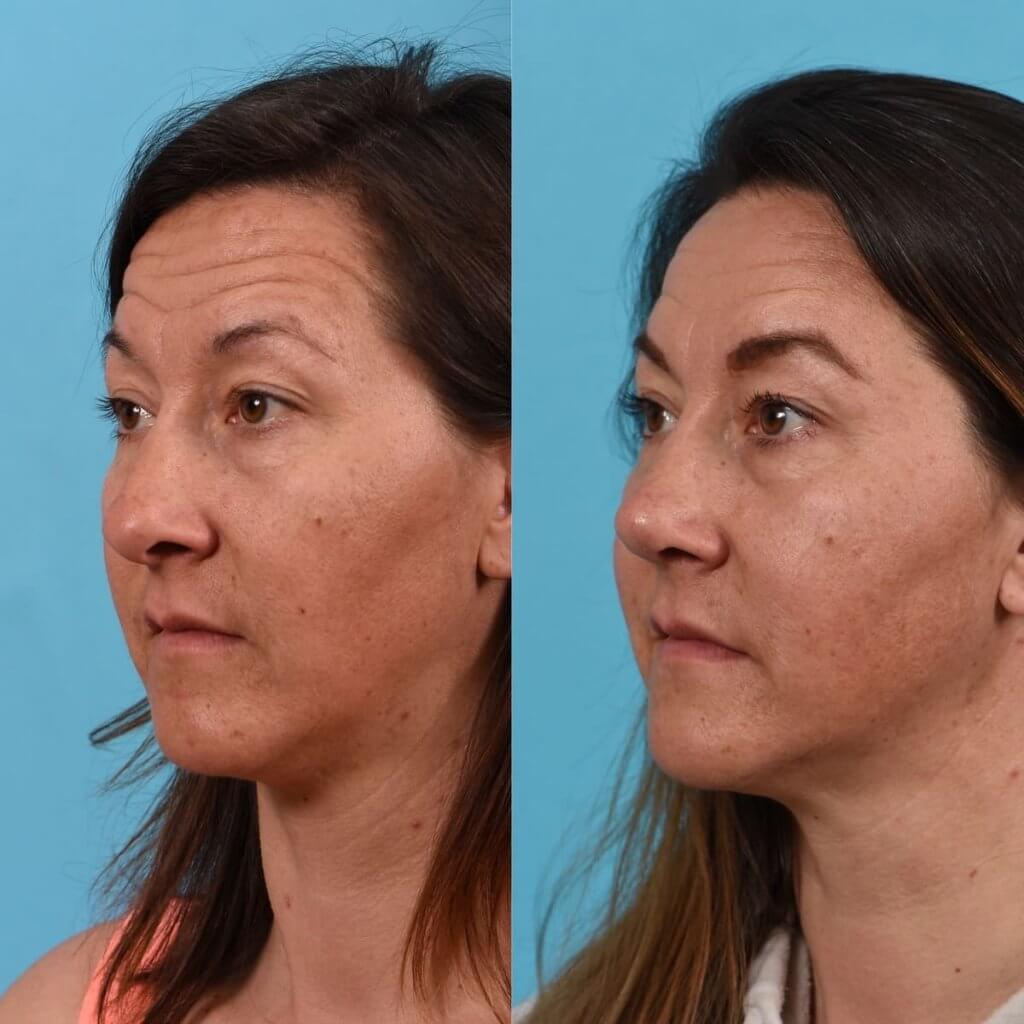 Female Patient Before and After Rhinoplasty