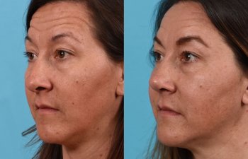 Female Patient Before and After Rhinoplasty
