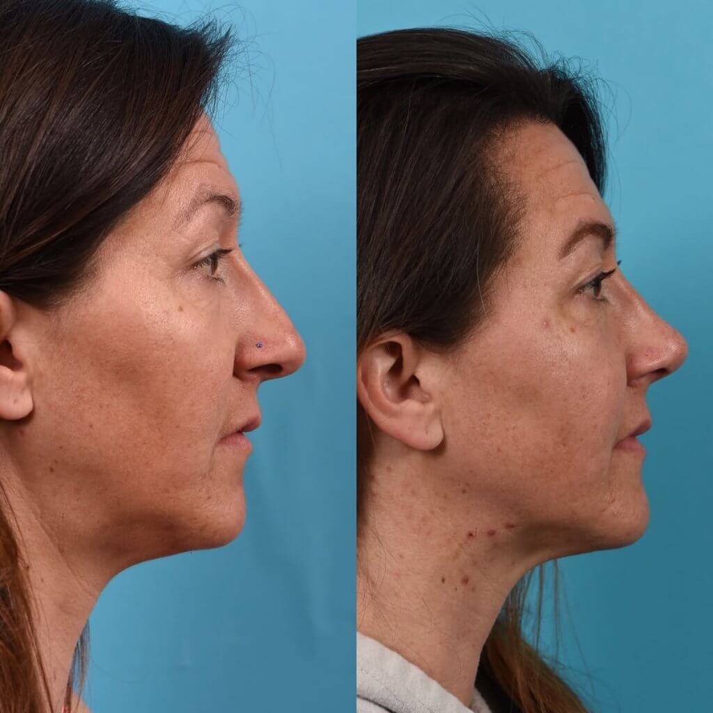 Female Patient Before and After Rhinoplasty