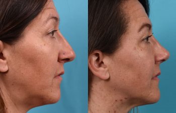 Female Patient Before and After Rhinoplasty