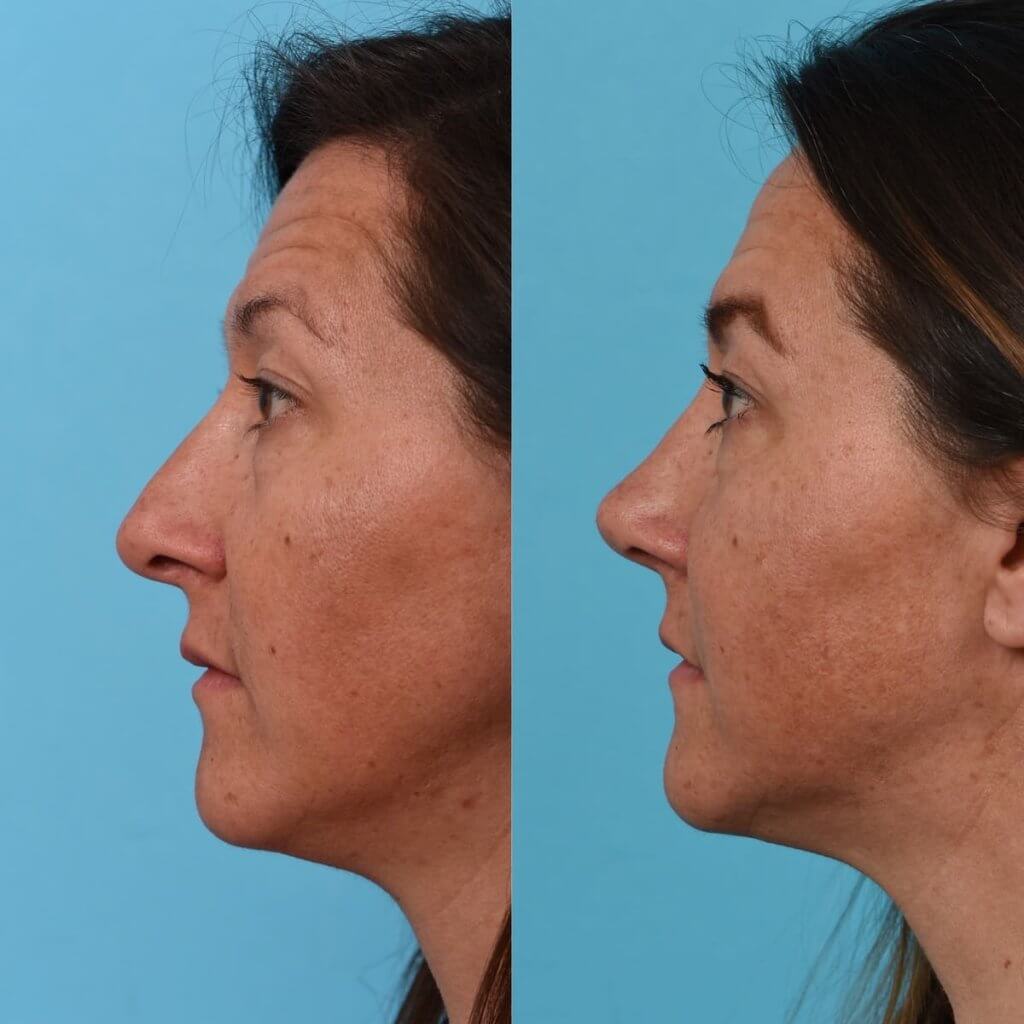 Female Patient Before and After Rhinoplasty