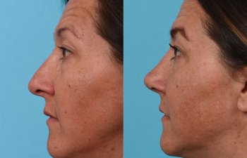 Female Patient Before and After Rhinoplasty