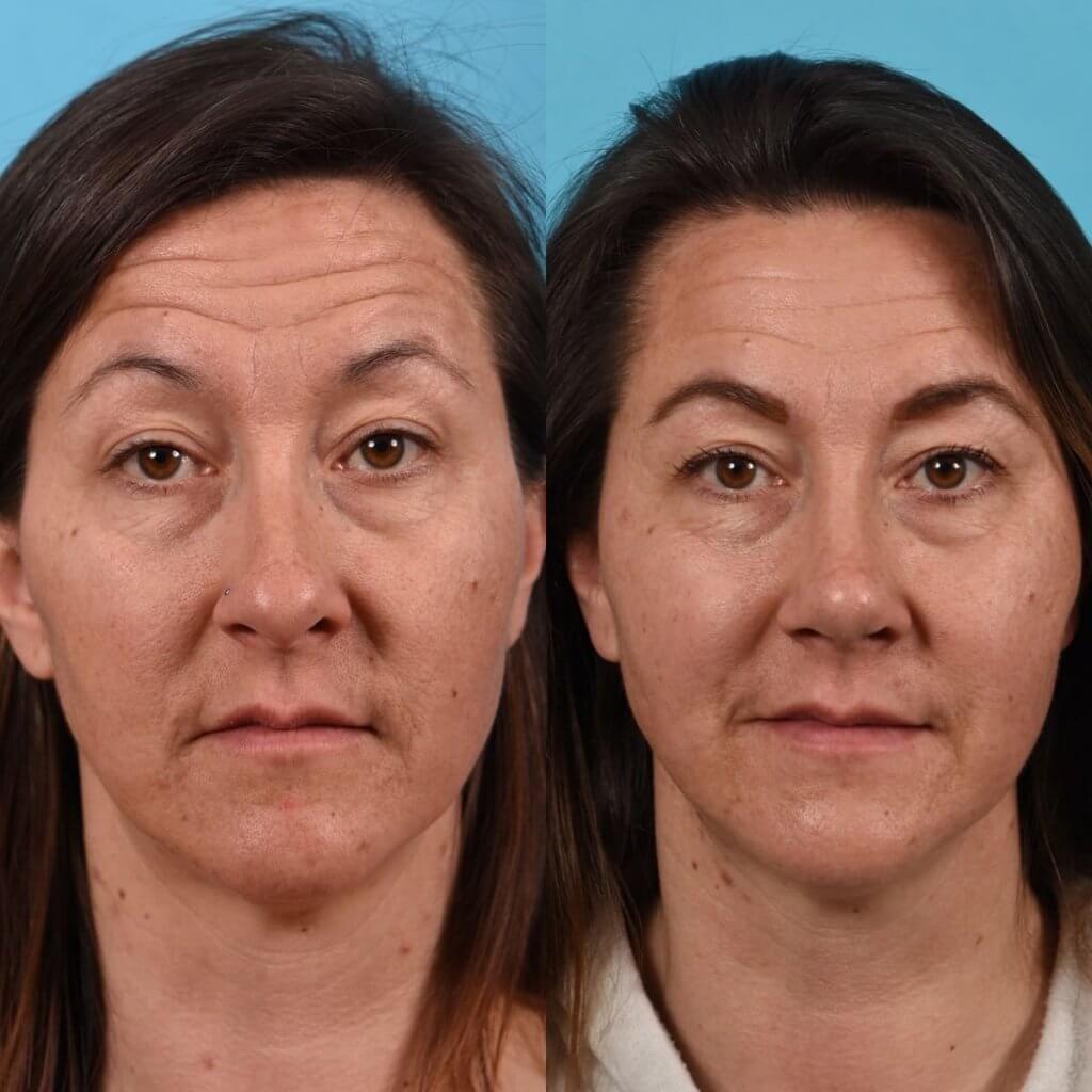 Female Patient Before and After Rhinoplasty