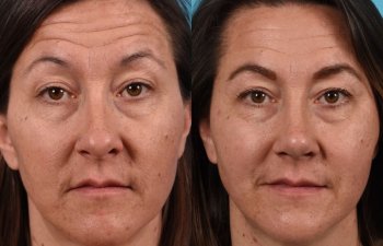 Female Patient Before and After Rhinoplasty