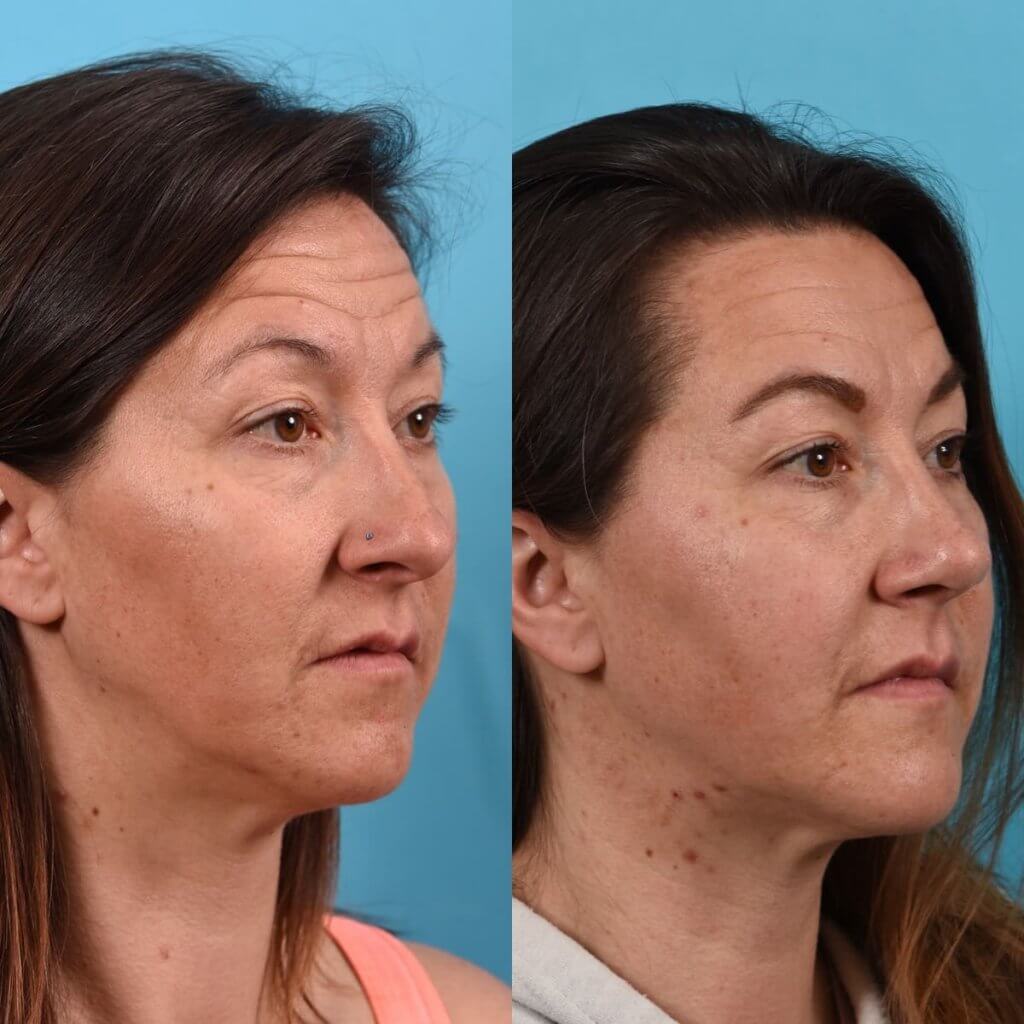 Female Patient Before and After Rhinoplasty