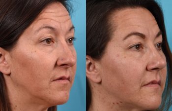Female Patient Before and After Rhinoplasty