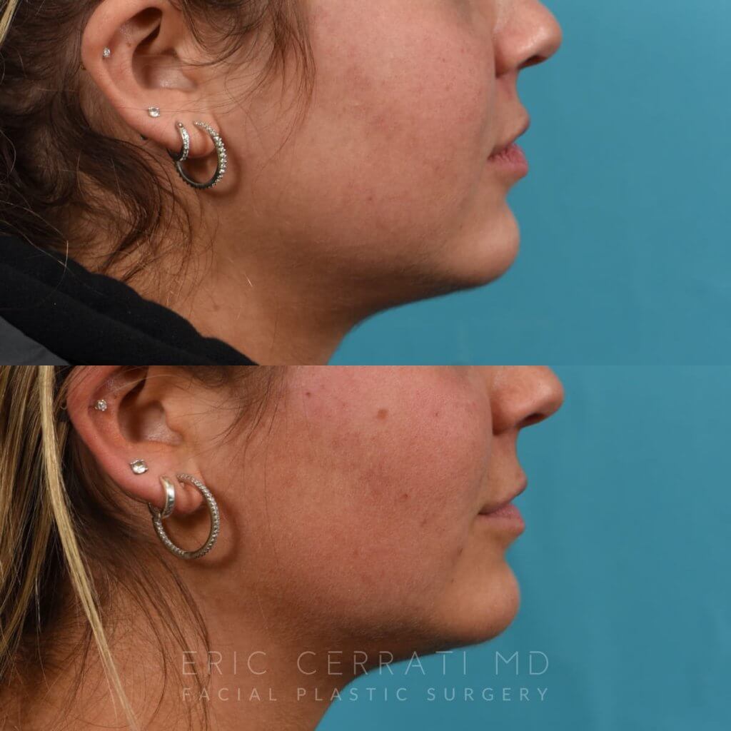 Photos of a woman's face before and after cheek reduction - from the front