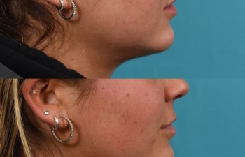 Photos of a woman's face before and after cheek reduction - from the front